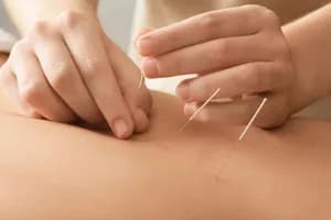 Medhealth Physiotherapy - Acupuncture - acupuncture in Hamilton, ON - image 2