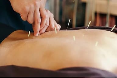 TCM Acupuncture - Barrie - acupuncture in Barrie