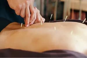 TCM Acupuncture - Barrie - acupuncture in Barrie, ON - image 2