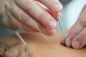 Athens Physiotherapy Clinic - Acupuncture - acupuncture in Athens, ON - image 1